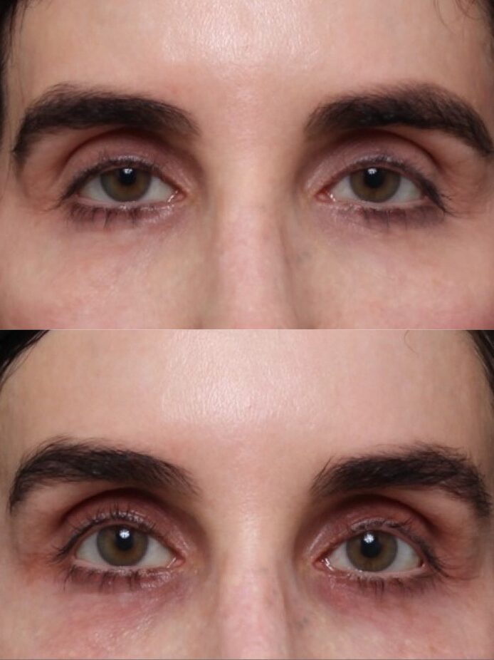 Fasanella Ptosis Repair