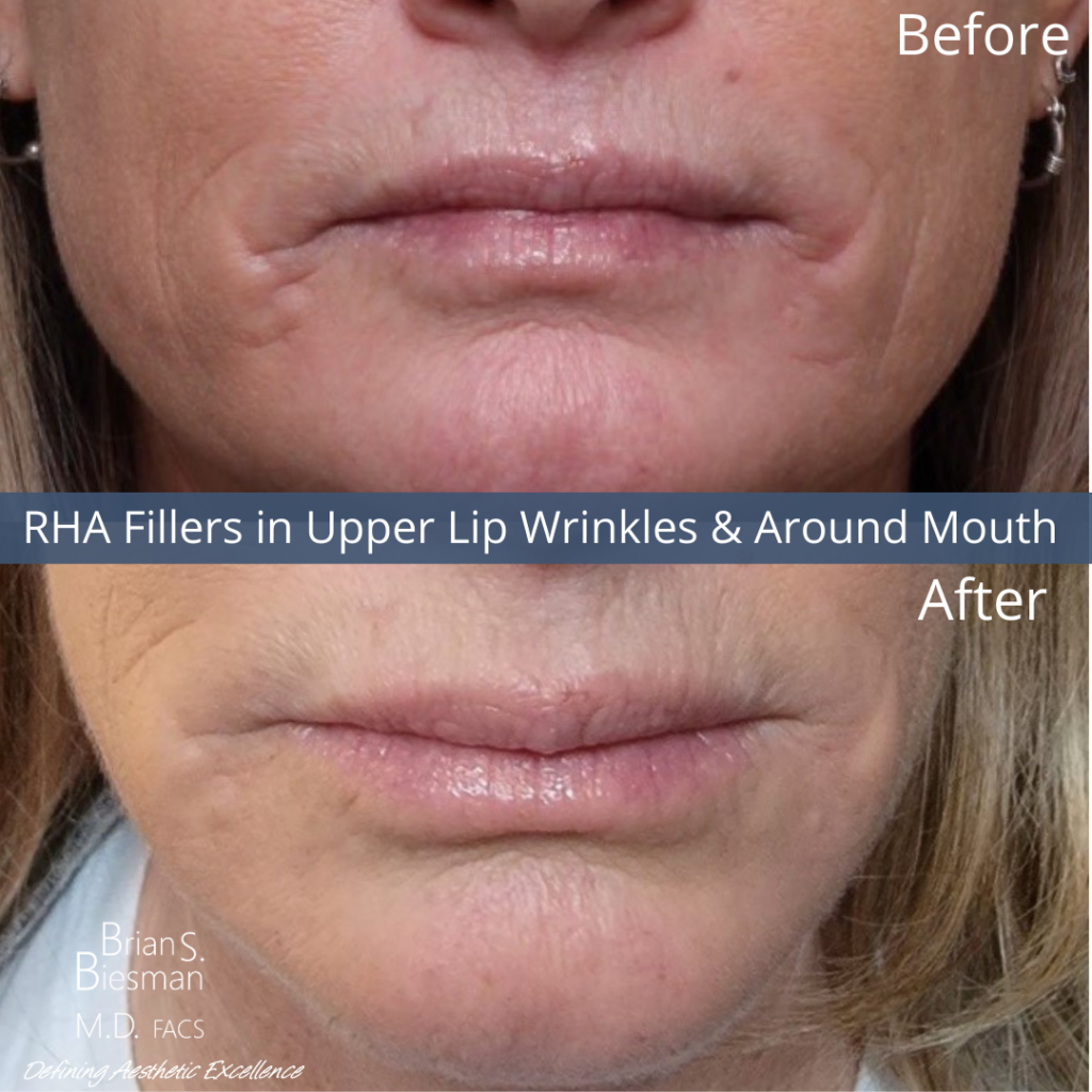 RHA Fillers in Perioral Lines