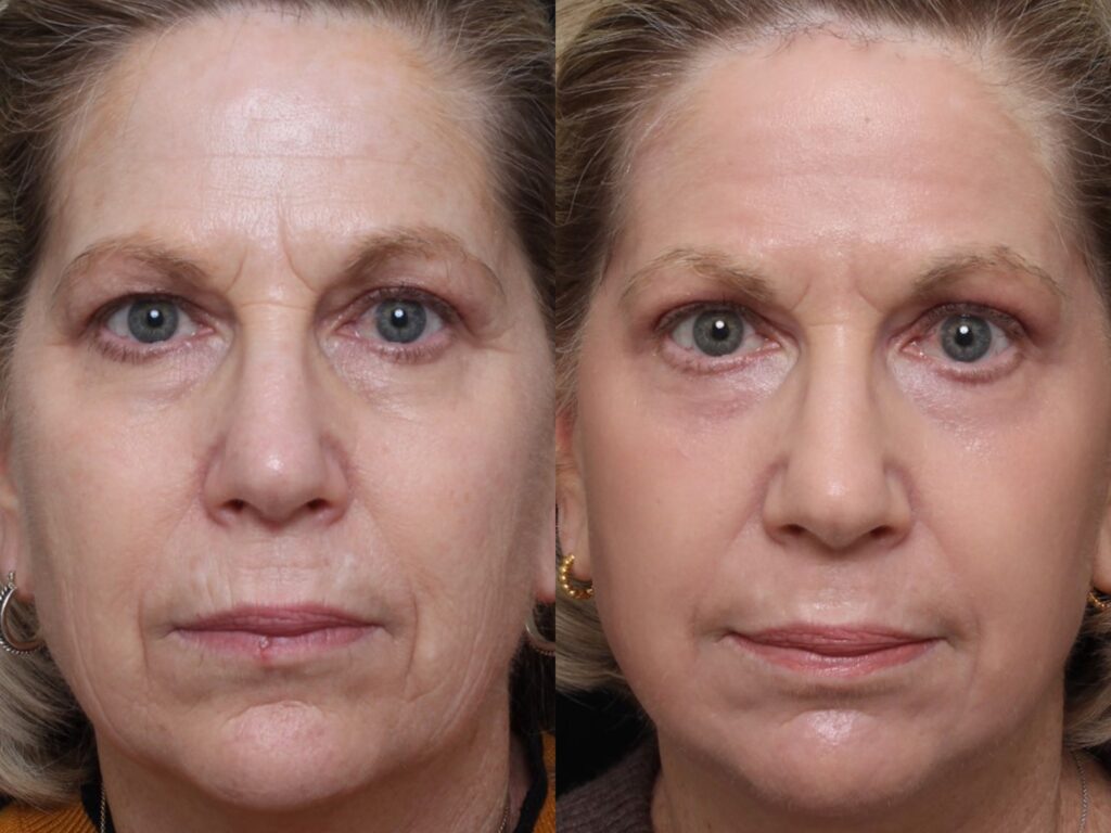 Skin Resurfacing Treatment