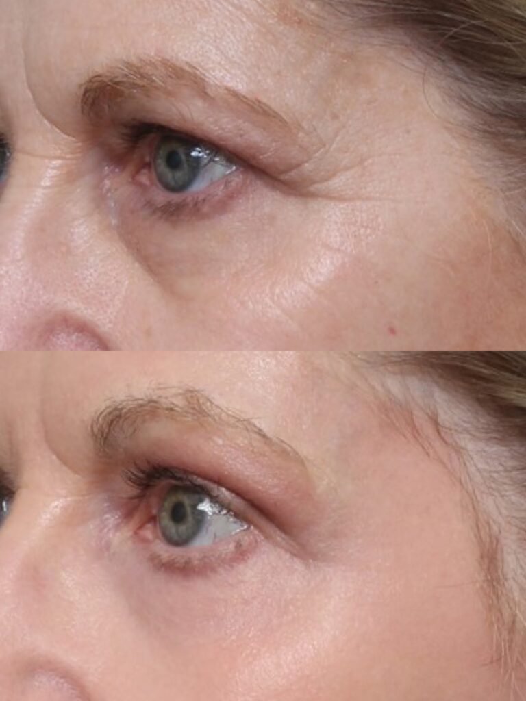 Skin Resurfacing Treatement