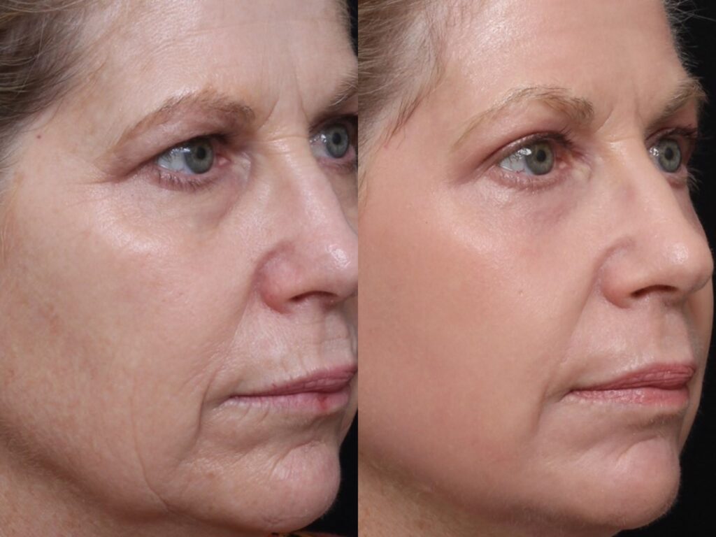 Full Ablative Fractional Laser Skin Resurfacing Treatement -Results & © Brian S. Biesman, M.D