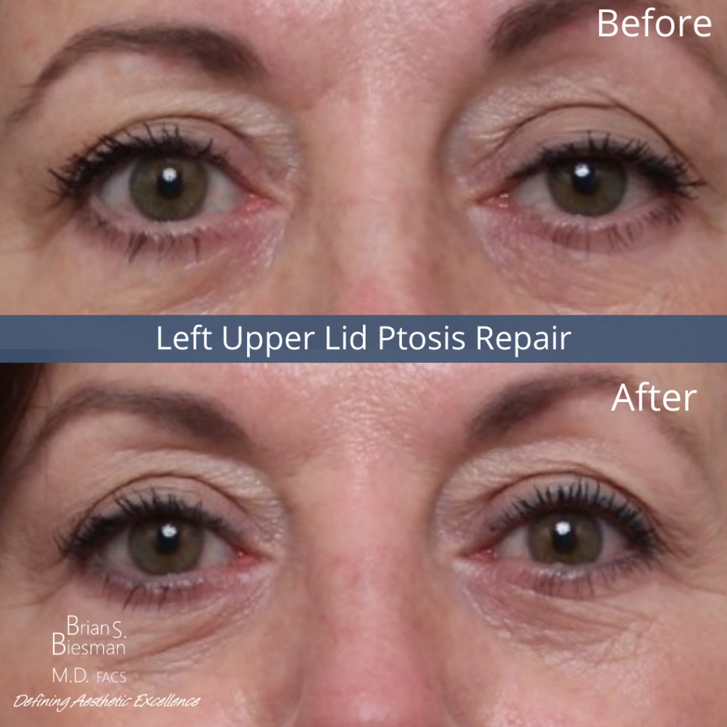 Left Upper Lid Ptosis Repair