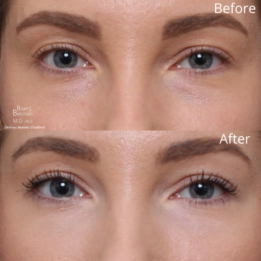 Tear Trough Filler