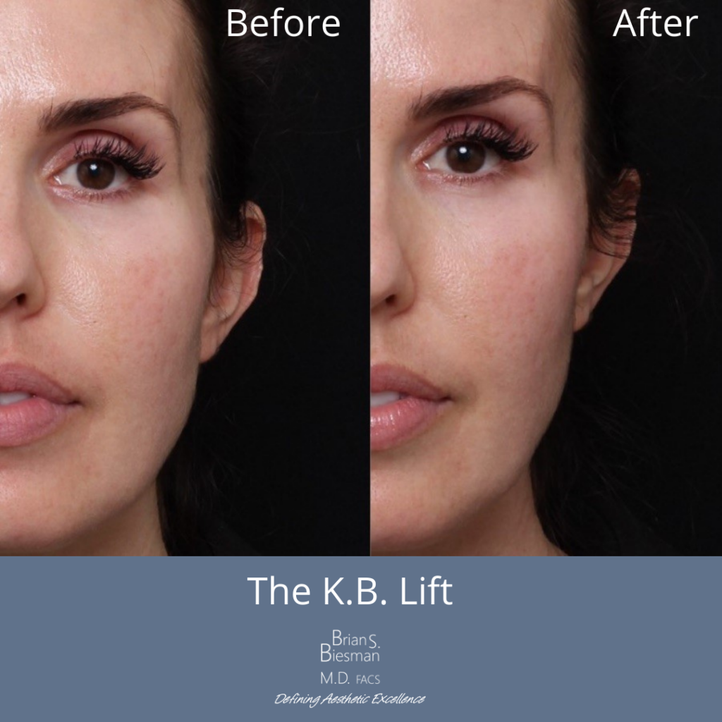 The K.B. Lift