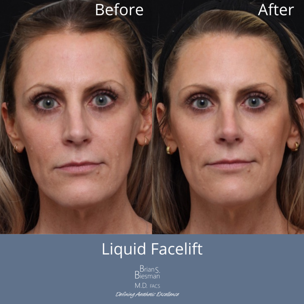 Liquid Facelift Before and After