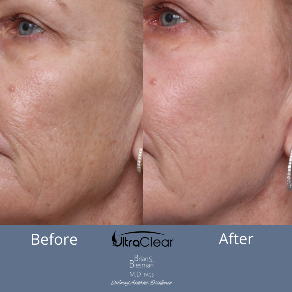 UltraClear Laser Skin Resurfacing
