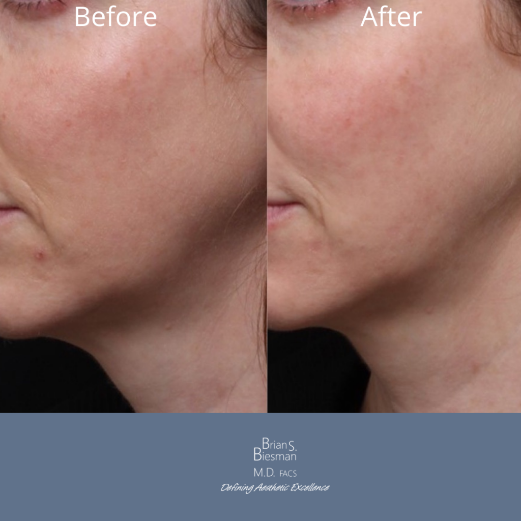 Jawline Contouring with Botox Nashville