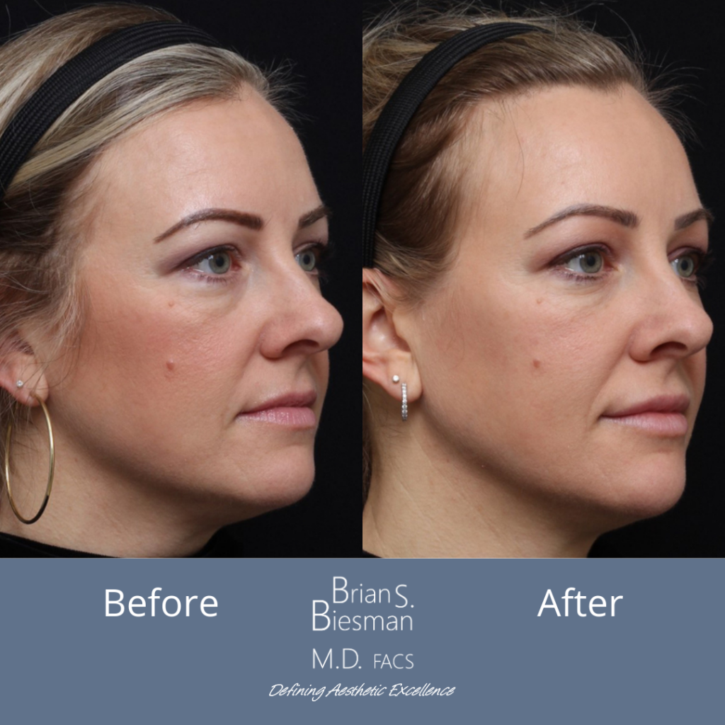 Injectable Face Lift
