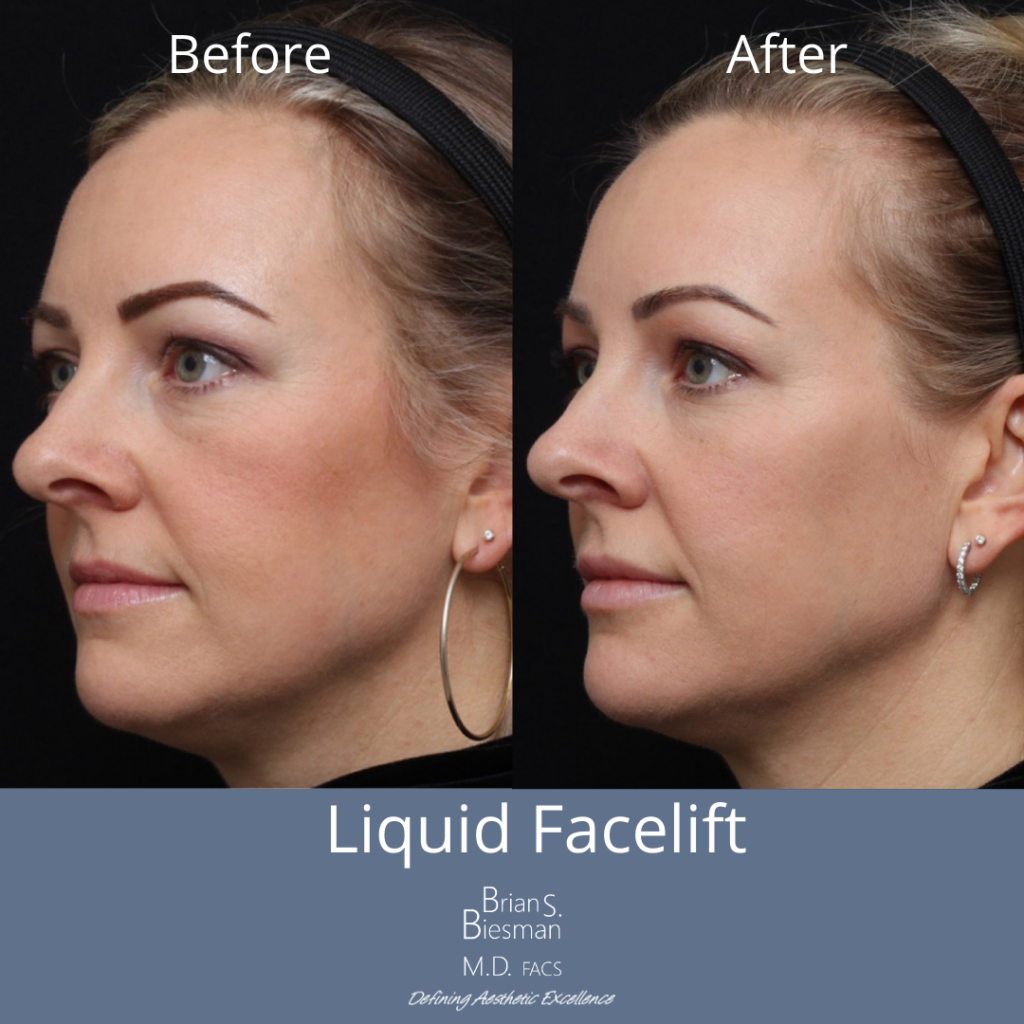Liquid Facelift