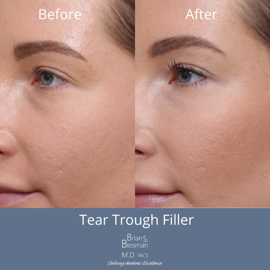 Tear Trough Filler