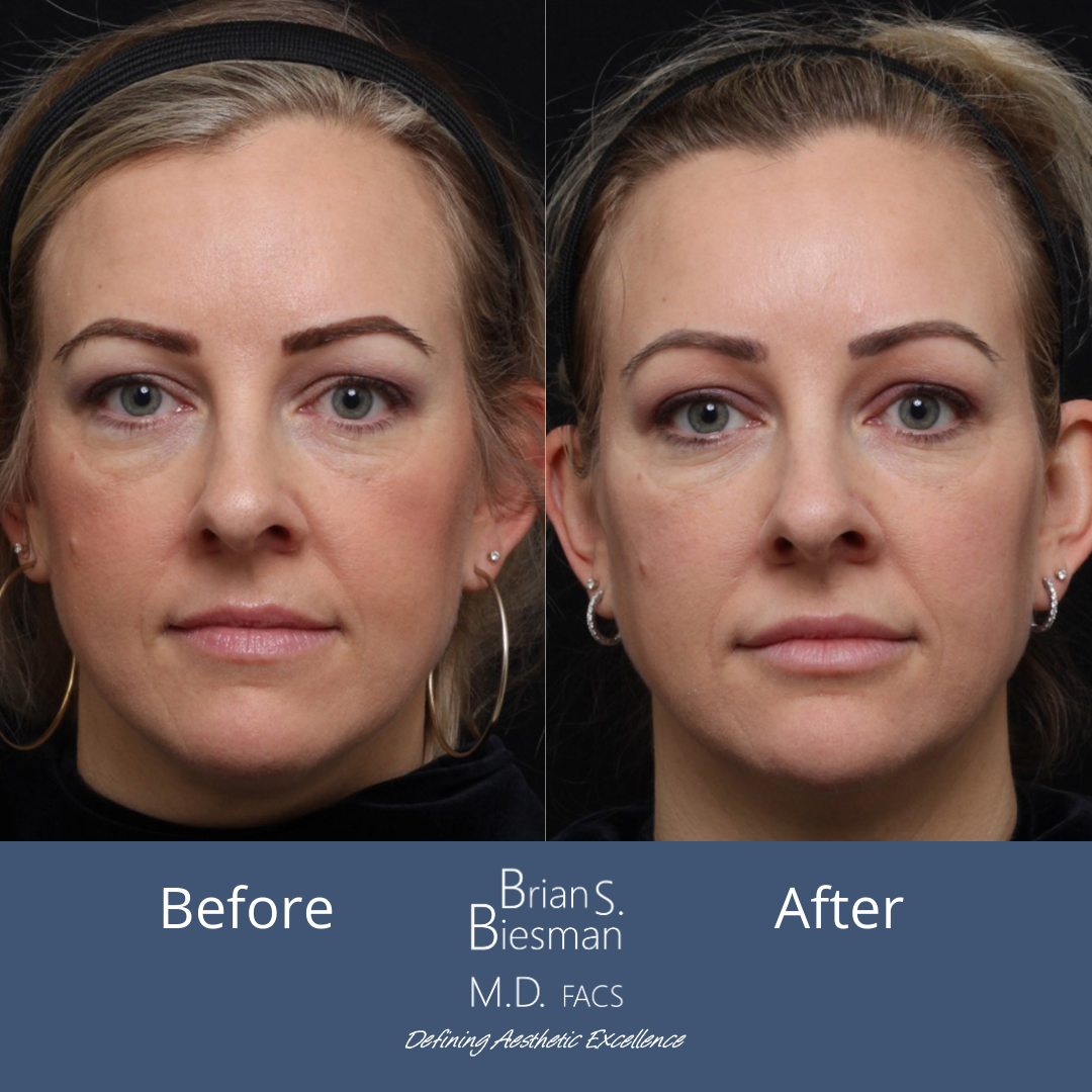 Restylane Lyft Before and After
