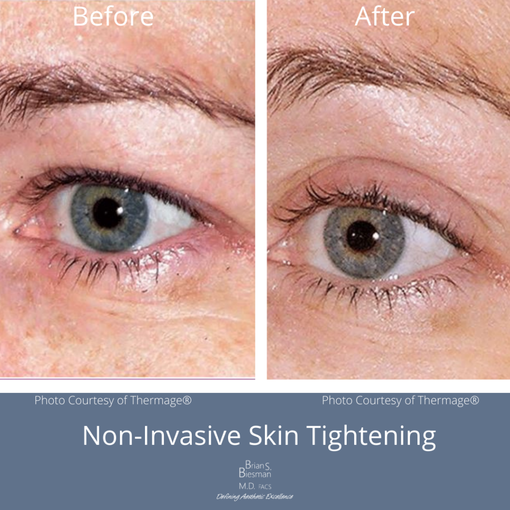 Thermage Non Invasive Eyelid Skin Tightening Nashville