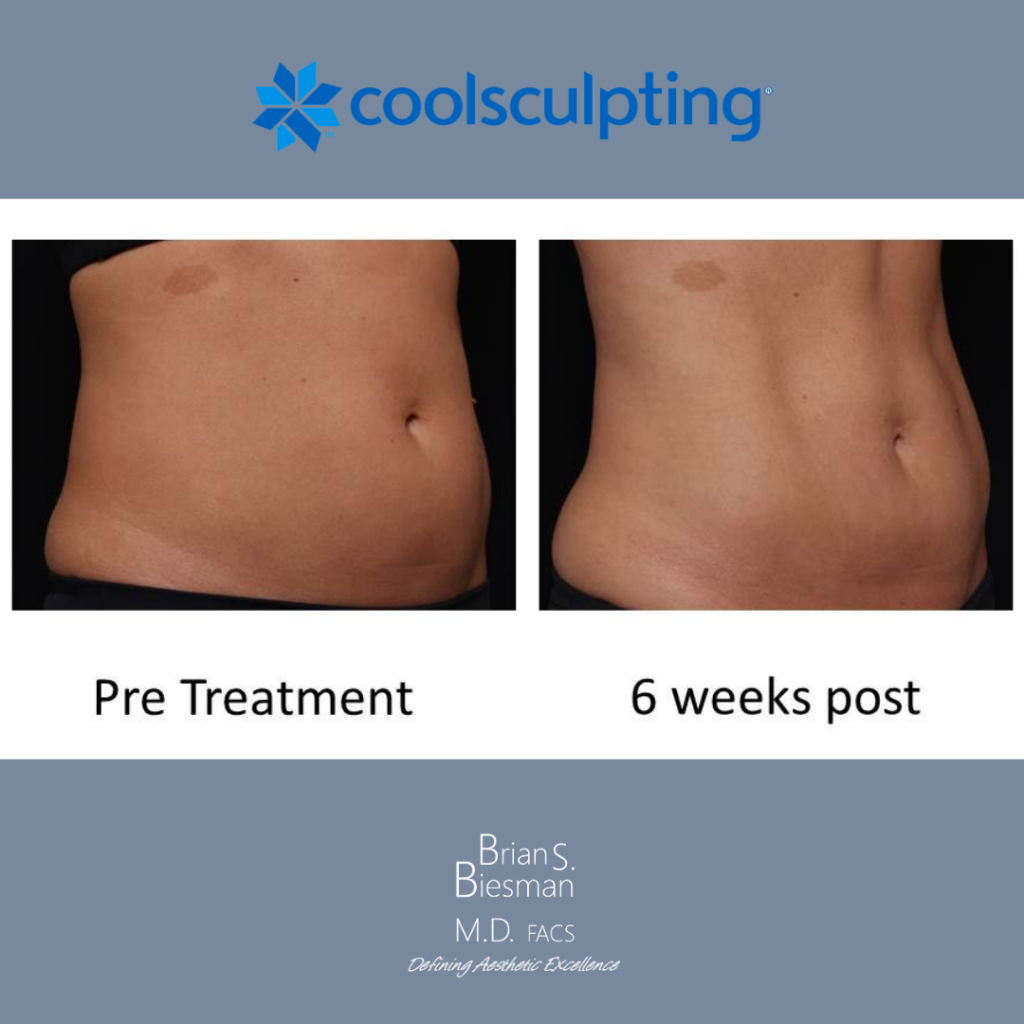 CoolSculpting NonInvasive Fat Reduction Nashville