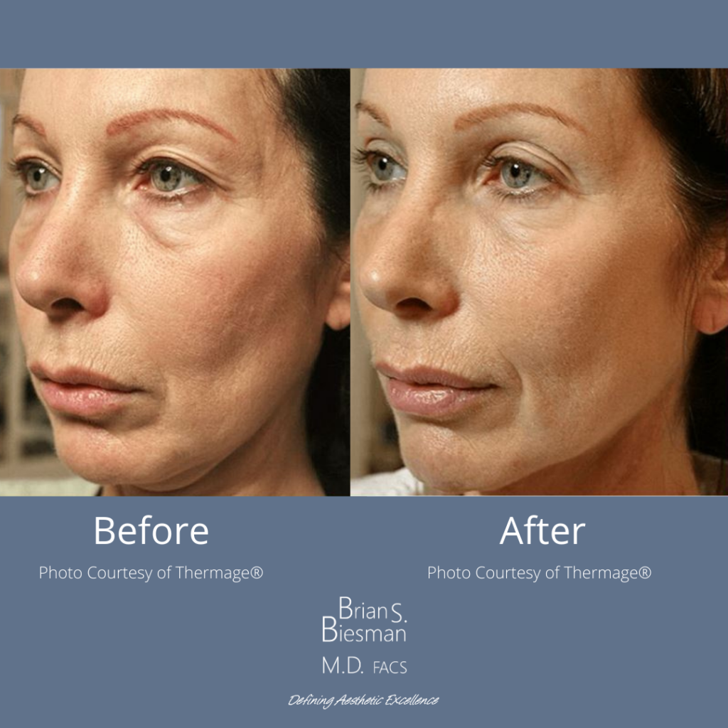Non Invasive Skin Tightening