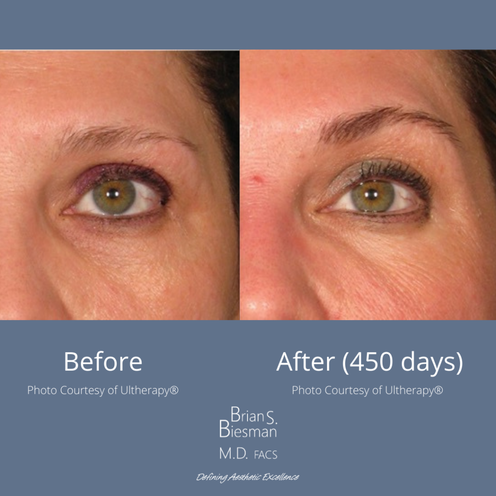 Ultherapy Non Invasive Tightening & Lifting