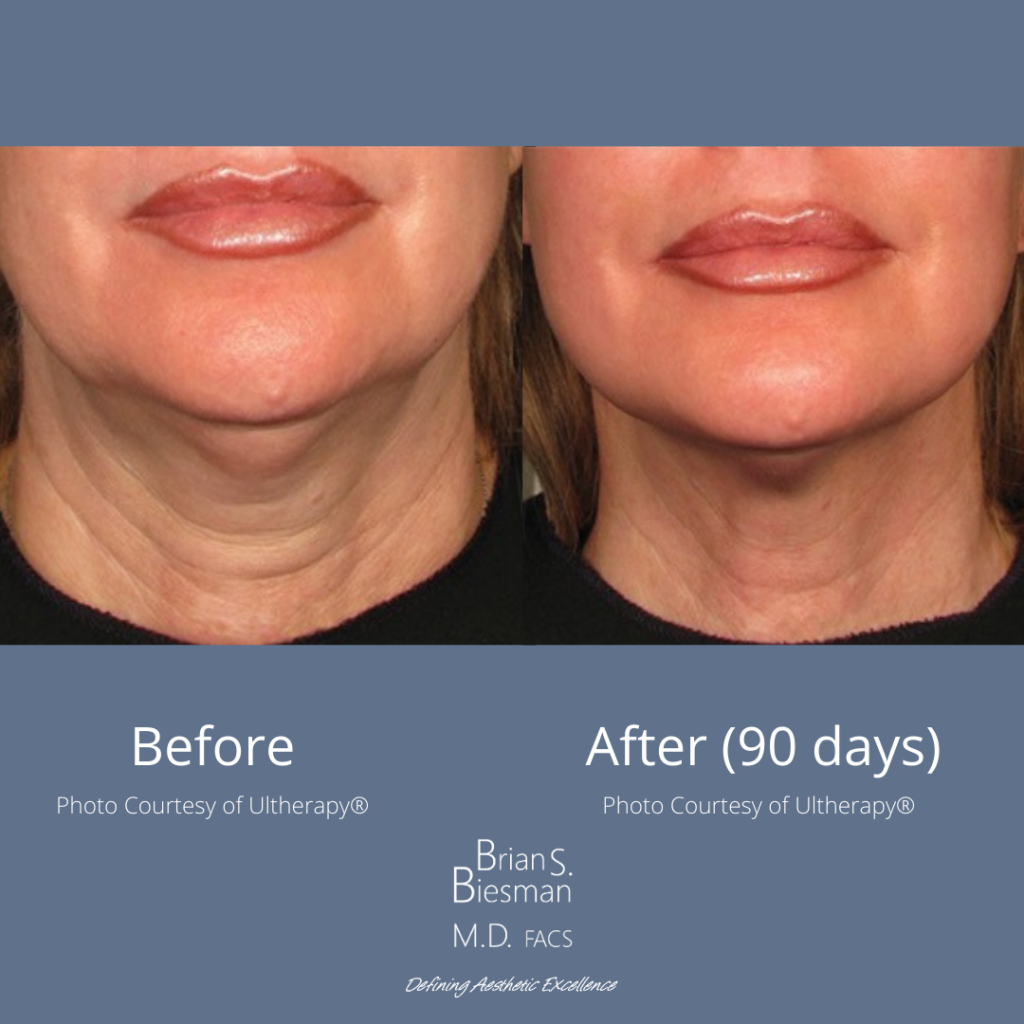 Ultherapy Non Invasive Tightening