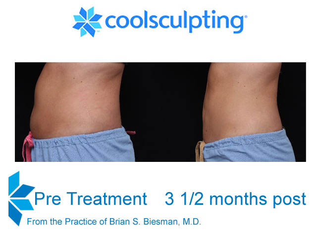 Cool Sculpting Non Invasive Fat Reduction - Results & © Brian S. Biesman, M.D.