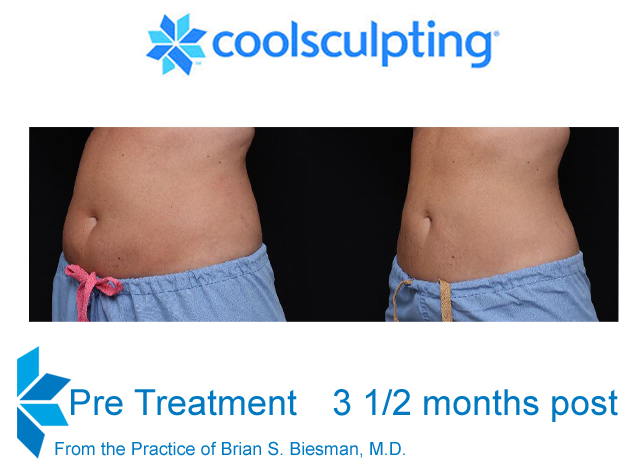 Cool Sculpting Non Invasive Fat Reduction - Results & Brian S. Biesman, M.D.