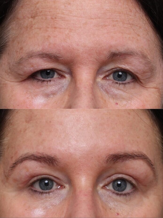 Eyelid Surgery Nashville
