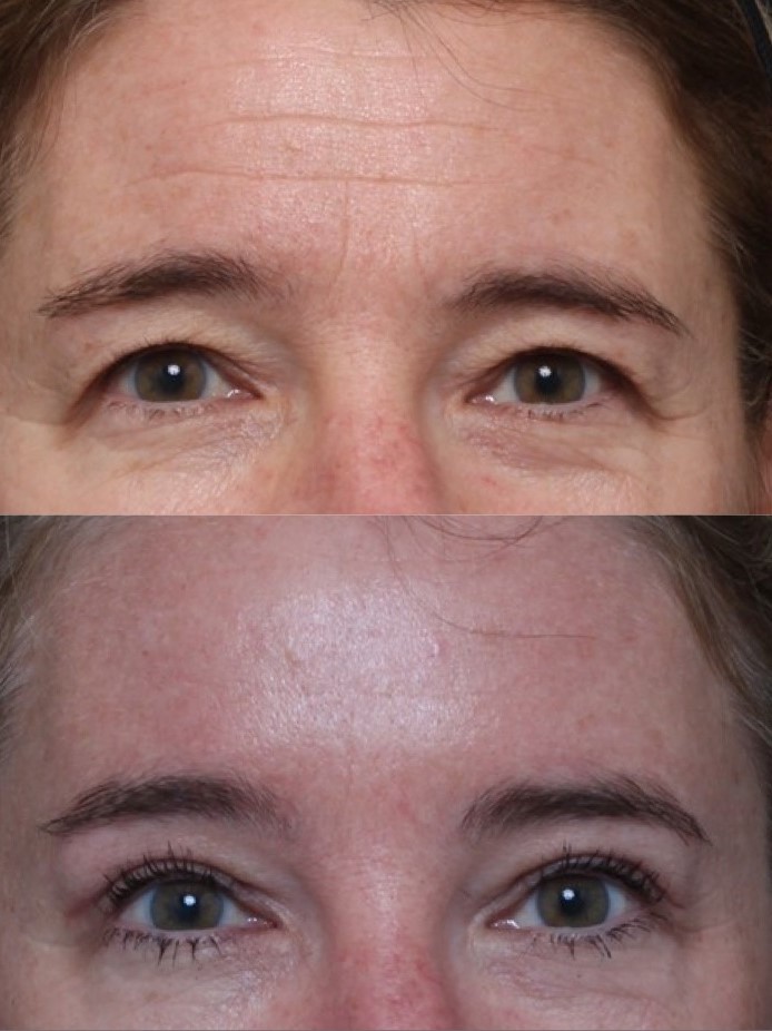Endoscopic Brow Lifting