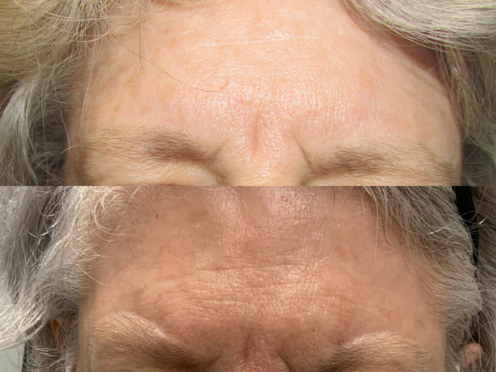 Direct Brow Lift