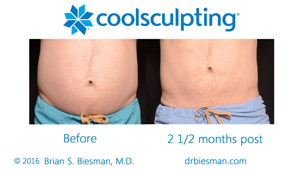 CoolSculpting NonInvasive Fat Reduction - Results & © Brian S. Biesman, M.D