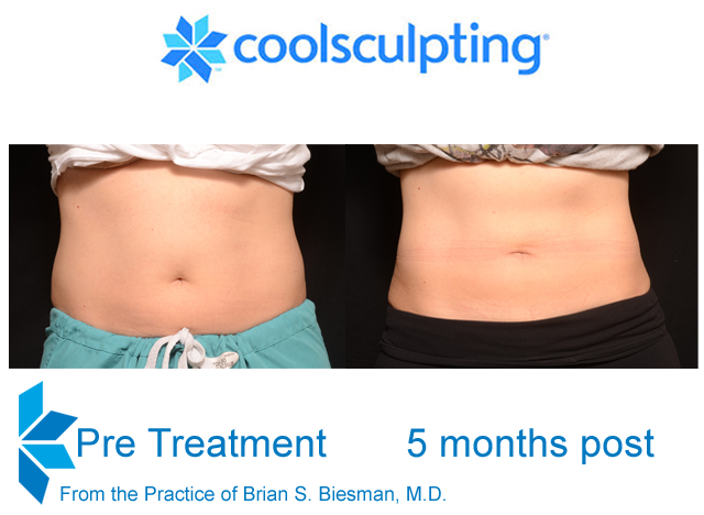 Cool Sculpting Non Invasive Results