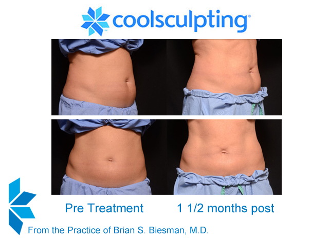 Cool Sculpting Non Invasive Fat Reduction - Results & © Brian S. Biesman