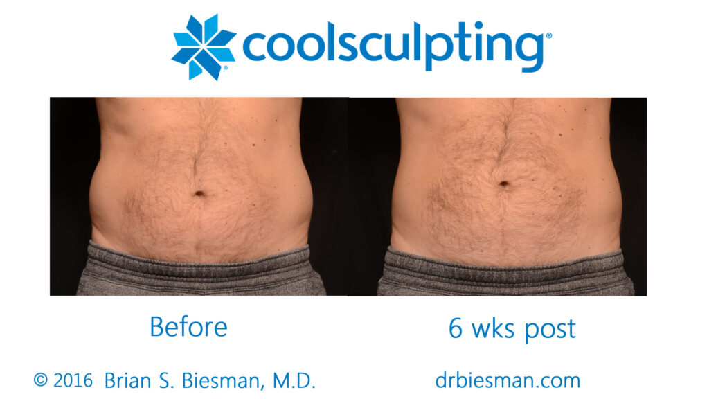 Cool Sculpting Non Invasive Fat Reduction - Results