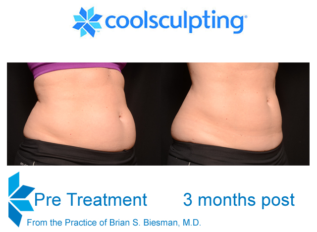 Cool Sculpting Non Invasive Fat Reduction