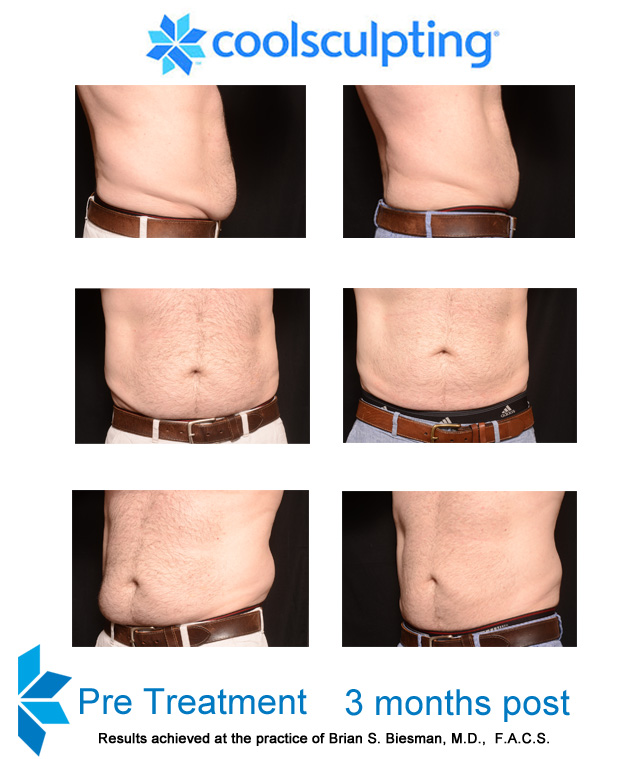 Cool Sculpting Non Invasive Fat Reduction