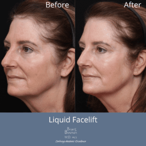 Botox Nashville Patient