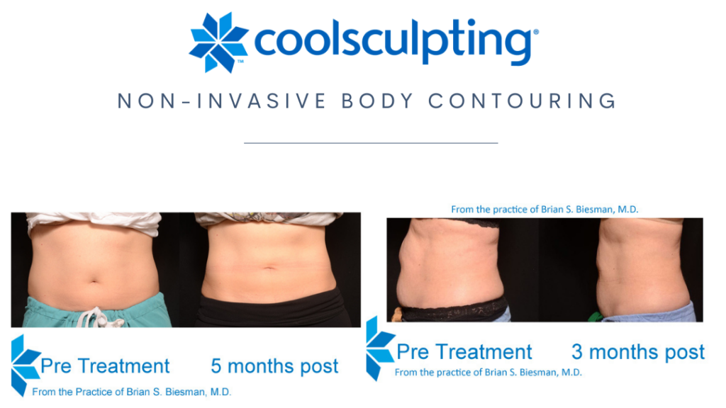 CoolSculpting 2