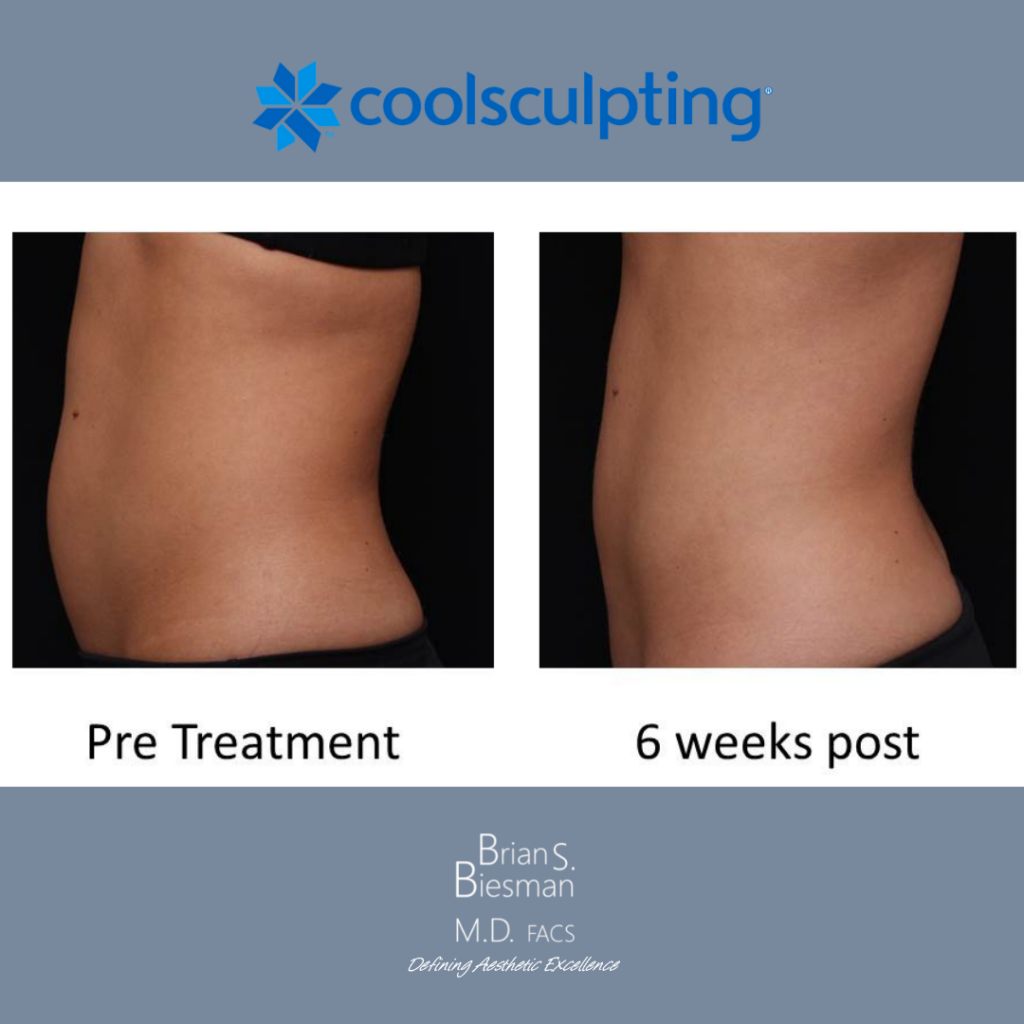 CoolSculpting 3