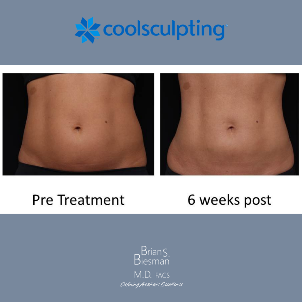 CoolSculpting 4