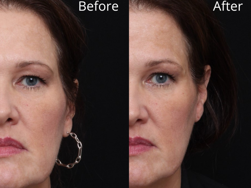 KB lift Before and After