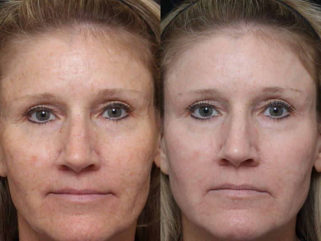 Ultraclear before and after