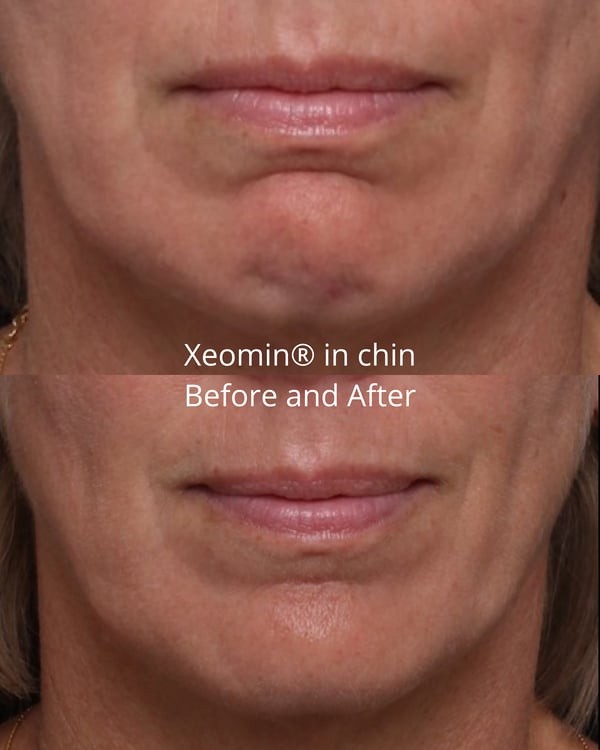 xeomin in Nashville